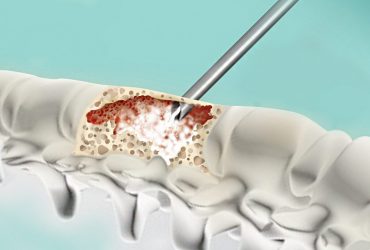 فراخوان همکاری در تولید سیمان استخوانی ارتوپدی بر پایه متیل متاکریلات