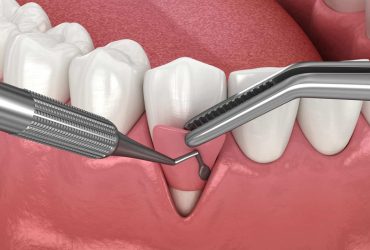 جراحی‌های دندان‌پزشکی با اسفنج نانویی چندمنظوره ساده‌تر می‌شود